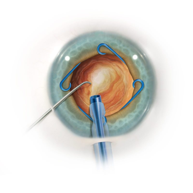 The Malyugin Ring Classic 6.25mm – MicroSurgical Technology