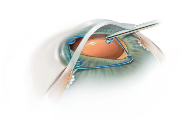 Intrascleral fixation of capsular bag and intraocular lens in cases with  large zonular dialysis | International Ophthalmology