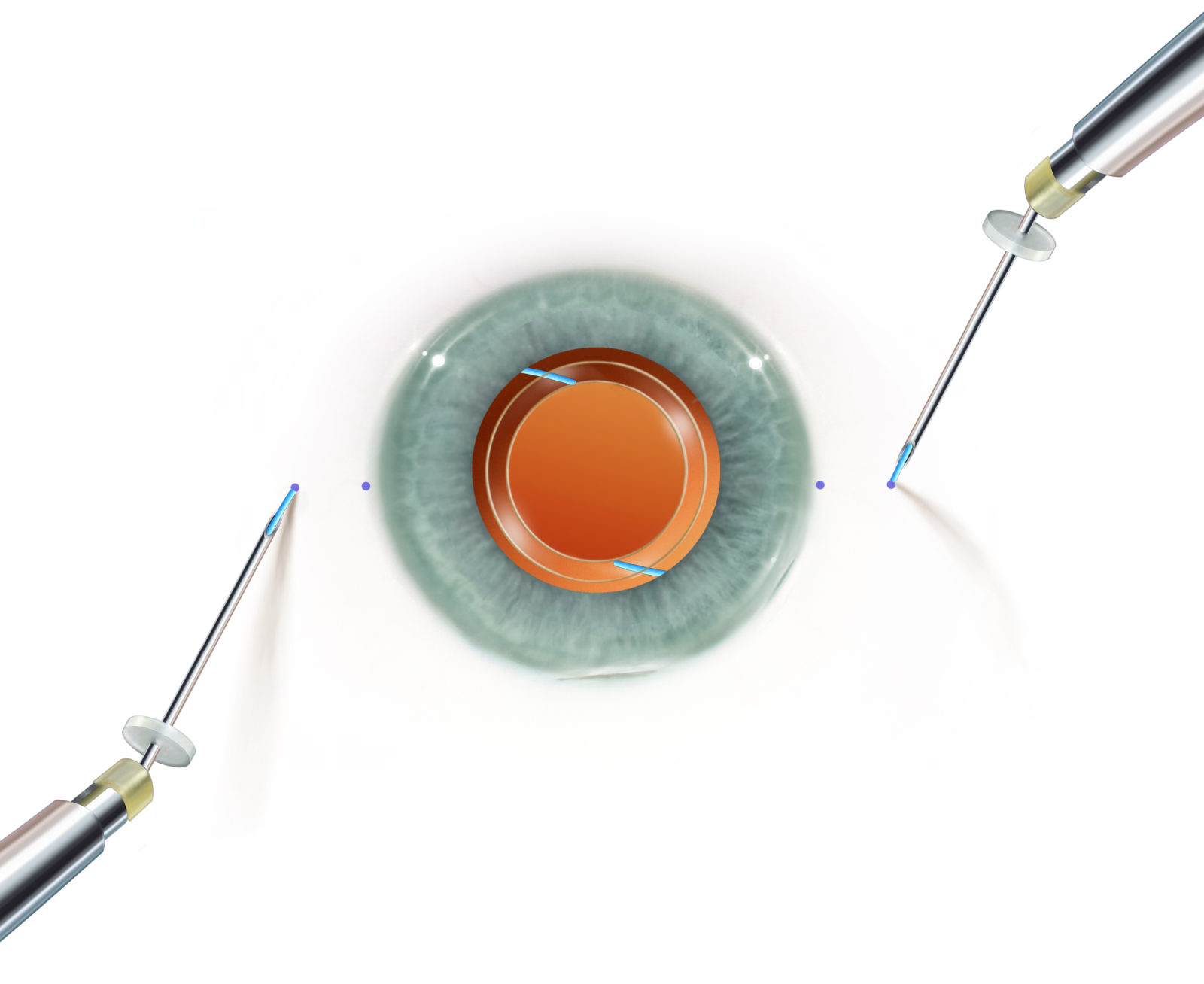 Scleral IOL Fixation Solutions Pack MicroSurgical Technology